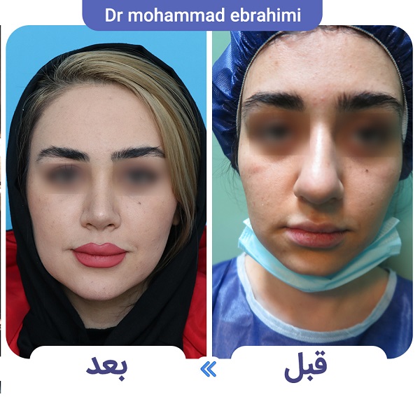 عوارض عمل بینی سر بالا