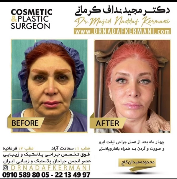 عوارض بوتاکس
