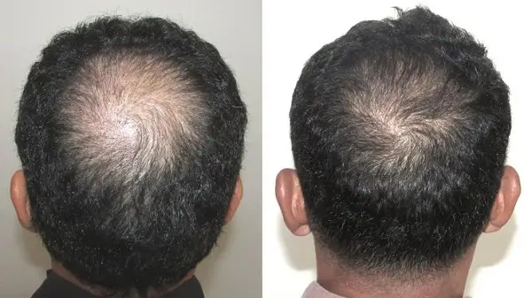 Adam_s - 9 Months of Treatment_ (1)
