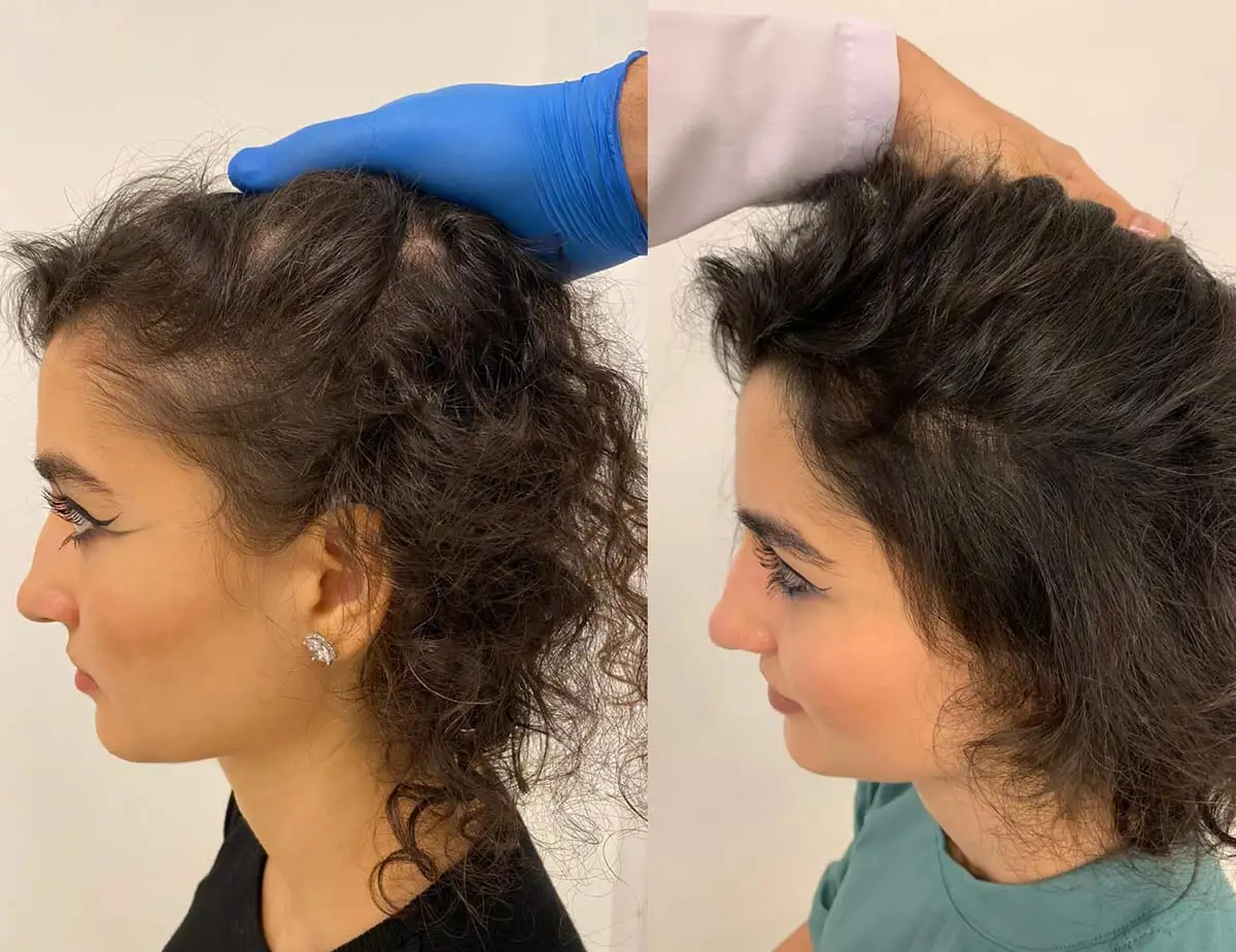 مزوتراپی جامع