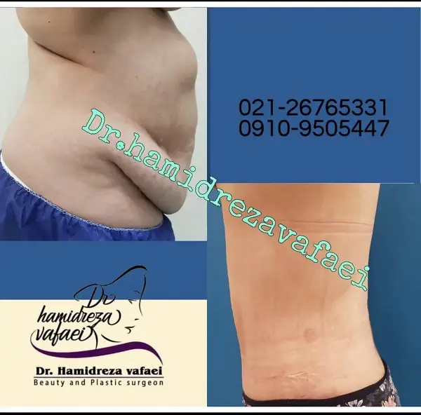 چگونه بهترین دکتر پیکر تراشی را بیابیم؟