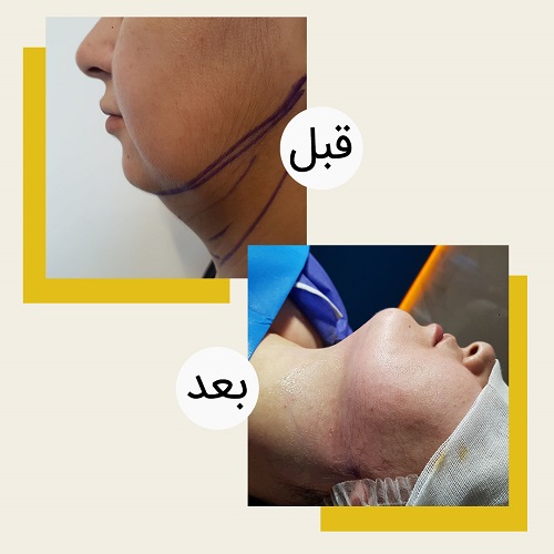 ساکشن غبغب چیست؟