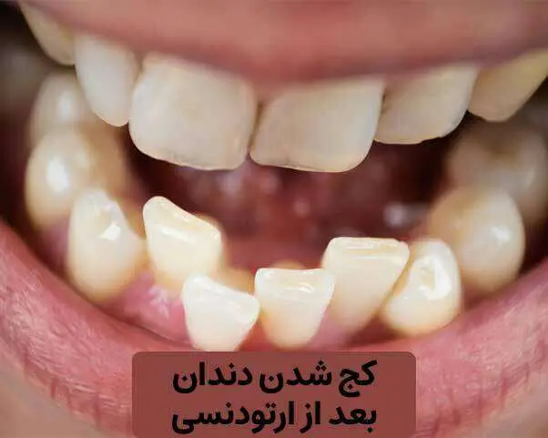 چرا بعد از ارتودنسی دندان کج می‌شود؟ عدم استفاده از ریتینر، برگشت حافظه استخوان فک، فشار زبان و عادات دهانی از مهم‌ترین دلایل کج شدن مجدد دندان‌ها پس از ارتودنسی هستند.