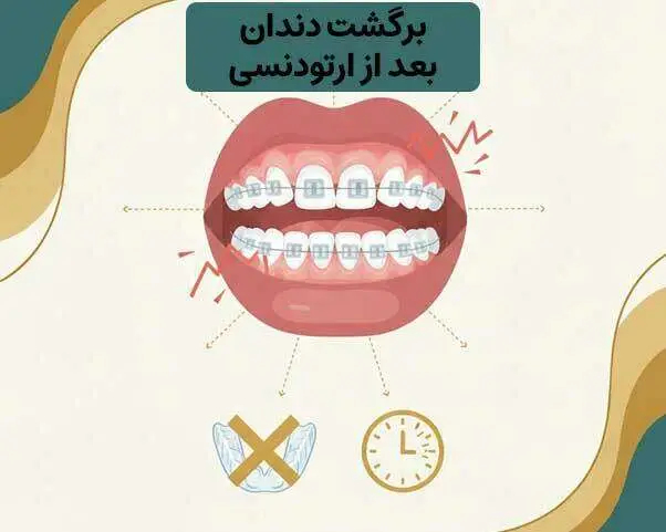 چرا بعد از ارتودنسی دندان کج می‌شود؟ عدم استفاده از ریتینر، برگشت حافظه استخوان فک، فشار زبان و عادات دهانی از مهم‌ترین دلایل کج شدن مجدد دندان‌ها پس از ارتودنسی هستند.
