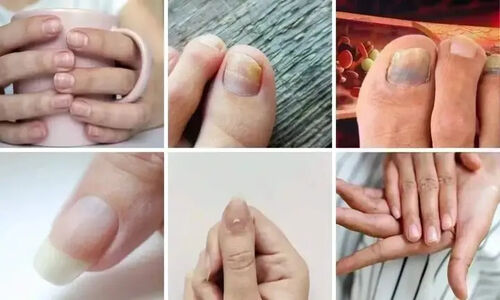 ۷ نشانه هشداردهنده کلسترول بالا که ناخن‌هایتان فریاد می‌زنند!