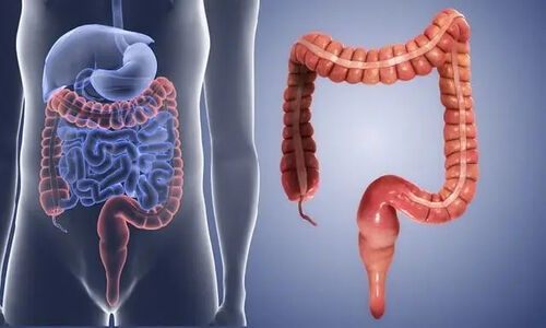 افزایش بیماری‌های التهابی روده در نسل جوان/ نقش کلیدی استرس و سبک زندگی