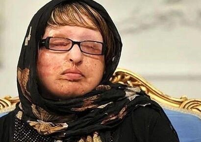 روایت ترسناک آمنه بهرامی از لحظه روبه‌رو شدن با خواستگار اسیدپاش ؛ از ترس به خودم لرزیدم